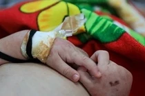 Bé 2 tuổi ở Cao Bằng tử vong nghi do mắc sởi