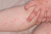 Hà Nội ghi nhận 290 ca bệnh tay chân miệng trong tuần 