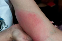 Người đàn ông nguy kịch tính mạng vì bị ong đốt hơn 150 vết