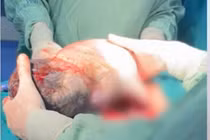 Hy hữu, em bé chào đời vẫn nằm nguyên trong túi ối