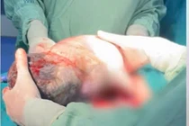 Hy hữu, em bé chào đời vẫn nằm nguyên trong túi ối
