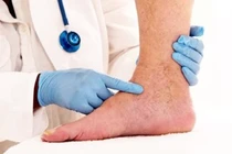 Chế độ dinh dưỡng cho người bệnh huyết khối tĩnh mạch sâu