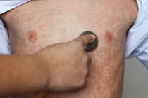 Ghi nhận 96 ca mắc sởi tại Hà Nội trong tuần qua