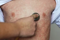 Ghi nhận 96 ca mắc sởi tại Hà Nội trong tuần qua