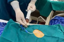 Cứu sống cụ ông 71 tuổi bị tràn dịch màng ngoài tim do lao