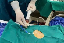 Cứu sống cụ ông 71 tuổi bị tràn dịch màng ngoài tim do lao