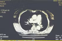 Cứu sống nữ bệnh nhân tắc động mạch phổi bằng kỹ thuật tiêu sợi huyết