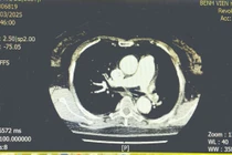 Cứu sống nữ bệnh nhân tắc động mạch phổi bằng kỹ thuật tiêu sợi huyết