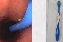 Hy hữu: Nuốt cả bàn chải đánh răng...khi tự “giải cứu” nghẹn họng