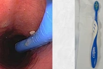 Hy hữu: Nuốt cả bàn chải đánh răng...khi tự “giải cứu” nghẹn họng