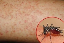 Cảnh báo nguy cơ sốt xuất huyết Dengue bùng phát 