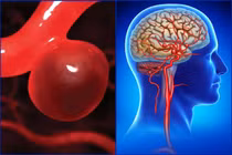 Đột ngột đau đầu dữ dội, người phụ nữ suýt tử vong