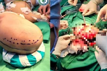 Mới 6 tháng tuổi đã xuất huyết não, hôn mê vì đột quỵ