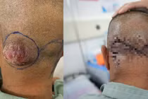 Phẫu thuật Mohs điều trị thành công hai ca ung thư da kích thước lớn 