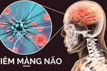 Viêm màng não do viêm tai giữa kéo dài nhiều năm