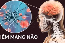 Viêm màng não do viêm tai giữa kéo dài nhiều năm