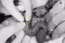 Cắt bỏ đoạn ruột 15 cm cứu bệnh nhi nuốt 20 viên bi nam châm