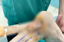 Tái tạo vết thương lở loét cả năm sau nhiều lần phẫu thuật do chó cắn