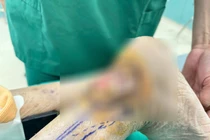 Tái tạo vết thương lở loét cả năm sau nhiều lần phẫu thuật do chó cắn