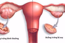 Suy buồng trứng sớm, dấu hiệu cảnh báo cần chú ý