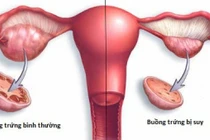 Suy buồng trứng sớm, dấu hiệu cảnh báo cần chú ý