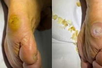 Bác sĩ mách cách chăm sóc và điều trị chai chân cho đúng