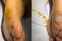 Bác sĩ mách cách chăm sóc và điều trị chai chân cho đúng