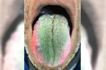 Lưỡi mọc lông xanh kỳ lạ vì uống thuốc kháng sinh quá liều