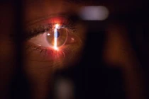 Con nhỏ keo 502 vào mắt, cách bố xử lý được bác sĩ khen