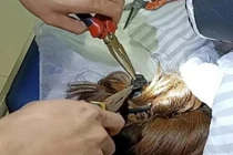 Kẹp tóc kiểu này, người phụ nữ suýt mất mạng