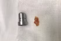 2 người phụ nữ suýt "mất Tết" vì hóc dị vật đường thở nguy hiểm