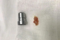 2 người phụ nữ suýt "mất Tết" vì hóc dị vật đường thở nguy hiểm