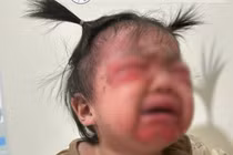 Cẩn trọng hội chứng bong vảy da do tụ cầu 