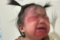 Cẩn trọng hội chứng bong vảy da do tụ cầu 