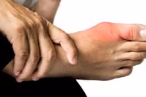 Nam sinh 17 tuổi mắc bệnh gout