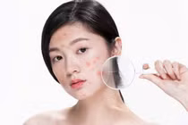 Những sai lầm trong chăm sóc da khiến càng chăm càng nhiều mụn