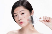 Những sai lầm trong chăm sóc da khiến càng chăm càng nhiều mụn