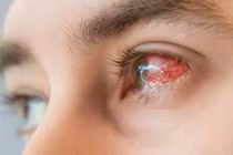 Thấy mắt mờ... đi khám phát hiện mắc bệnh giang mai