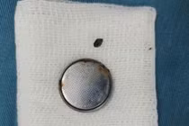 Bé gái 4 tuổi loét thực quản vì... nuốt phải pin đồng hồ