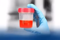 Đi tiểu ra máu, bé trai 7 tuổi mắc... viêm cầu thận cấp