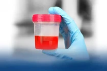 Đi tiểu ra máu, bé trai 7 tuổi mắc... viêm cầu thận cấp