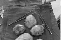 Kinh nguyệt không đều, đi khám bất ngờ phát hiện đa u xơ tử cung