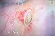 Đau bụng, buồn nôn, đi khám phát hiện thủng tạng rỗng do viêm loét dạ dày