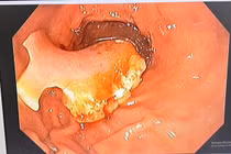 Người phụ nữ vô tình nuốt nguyên hàm răng giả khi uống thuốc