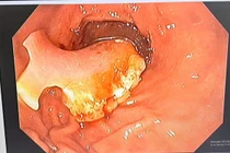 Người phụ nữ vô tình nuốt nguyên hàm răng giả khi uống thuốc