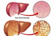 Top 9 thực phẩm giúp đẩy lùi bệnh gan nhiễm mỡ 