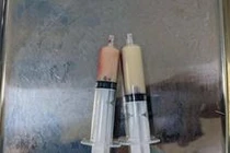 Huyết tương đục như sữa vì... nghiện rượu