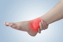 Sưng phù mắt cá chân dấu hiệu cảnh báo sức khỏe đang gặp vấn đề