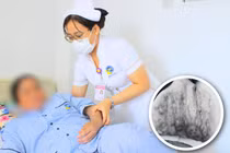 Giác hơi giảm căng thẳng, người phụ nữ bị bỏng nặng