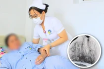 Giác hơi giảm căng thẳng, người phụ nữ bị bỏng nặng